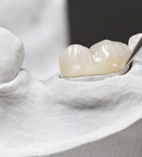 An up-close image of a dental professional placing a customized dental crown onto a mouth mold