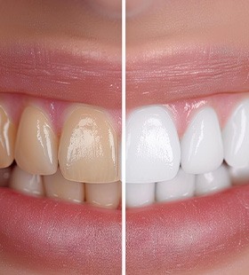 Up-close view of stained and brighter teeth