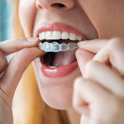 Female holding her Invisalign aligner in preparation for putting it in