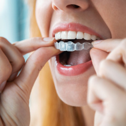 Female holding her Invisalign aligner in preparation for putting it in