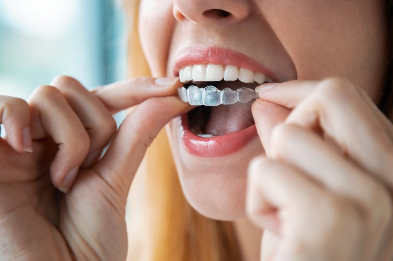 woman inserting Invisalign aligner into mouth