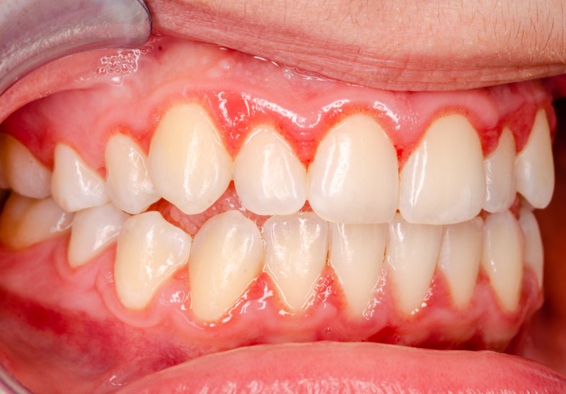 up-close view of a person with gingivitis